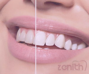 Blanchiment des dents