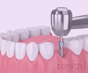 Implant dentaire