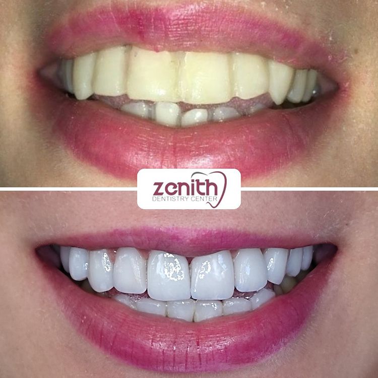 facette hollywood smile
