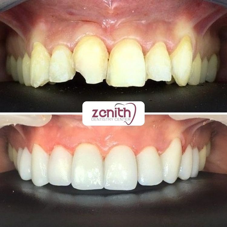 facette hollywood smile