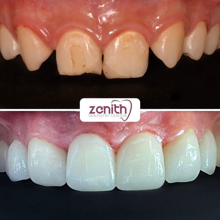 facette hollywood smile