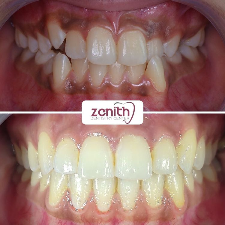 orthodontie alignement