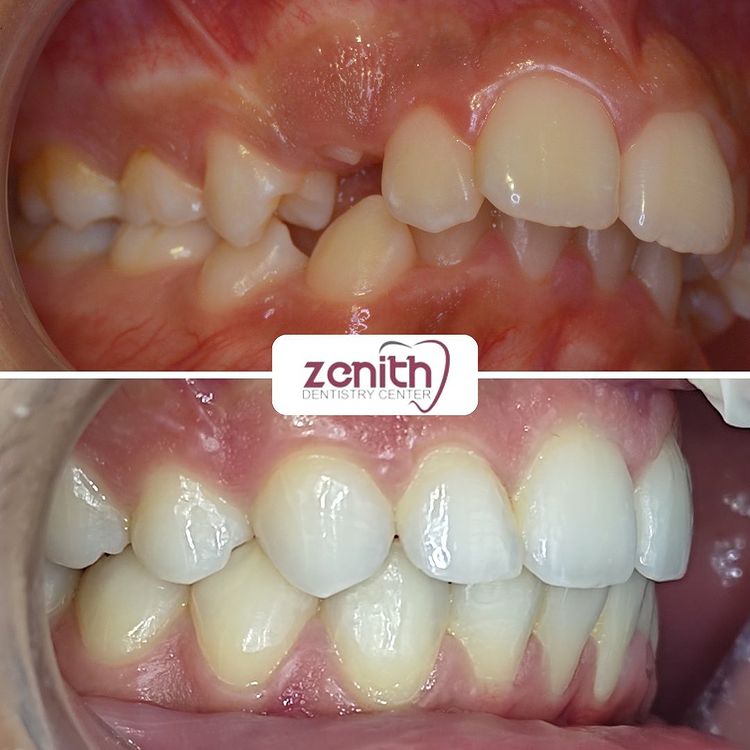 orthodontie alignement