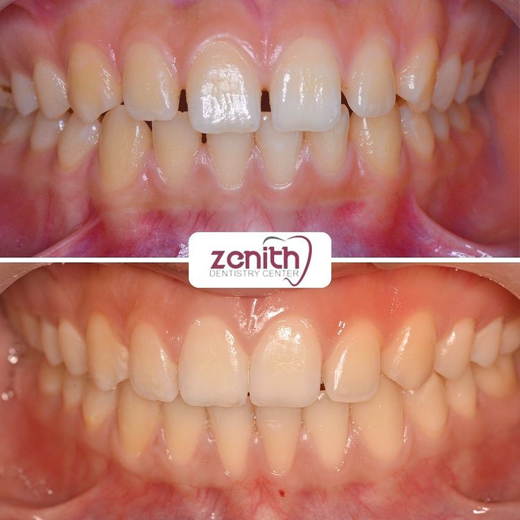 orthodontie alignement