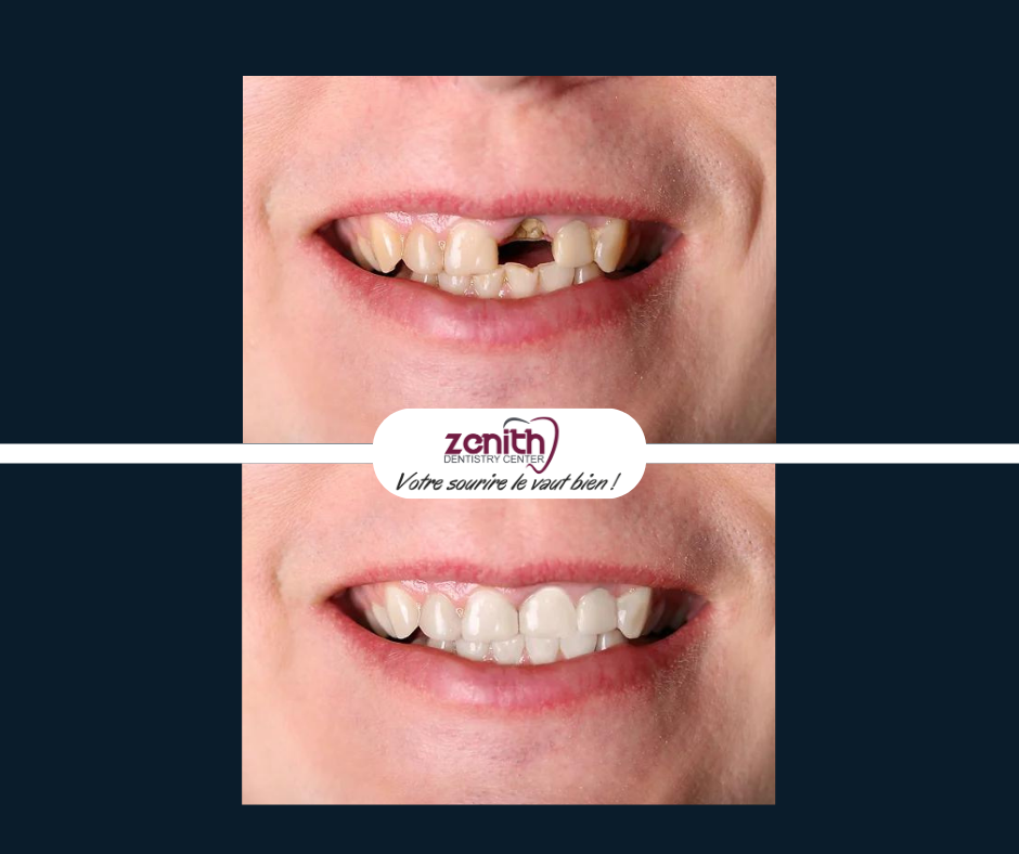 Dents manquantes avant apres