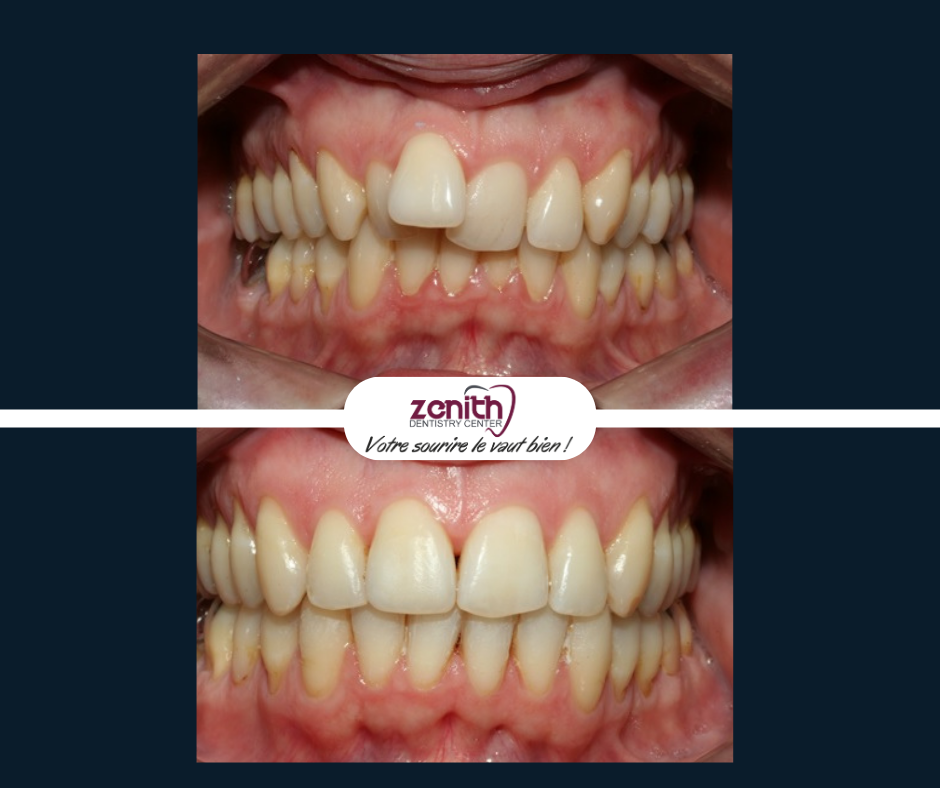 Occlusodontie machoire avant et apres