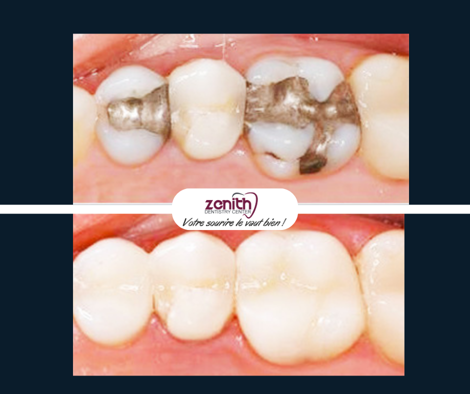 Rage de dents avant apres